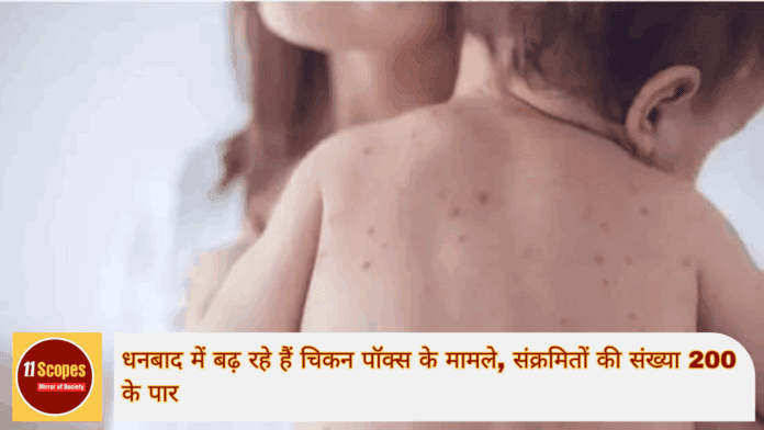 धनबाद में बढ़ रहे हैं चिकन पॉक्स के मामले, संक्रमितों की संख्या 200 के पार